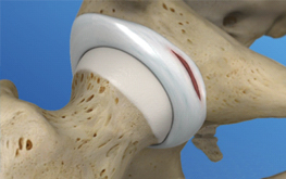 Hip joint labral
