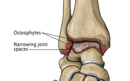 Ankle Arthritis