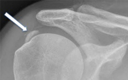 Calcific tendinopathy