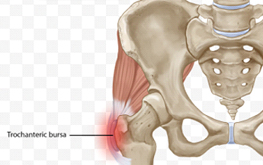 Greater Trochanteric Pain