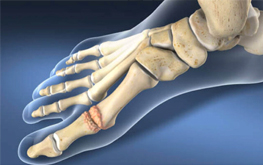 Hallux rigidus