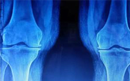 Knee Osteoarthritis