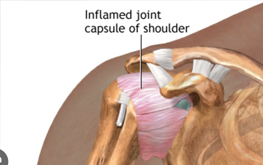 frozen shoulder