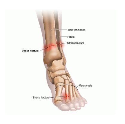 Stress Fractures