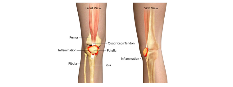 pattellofemoral