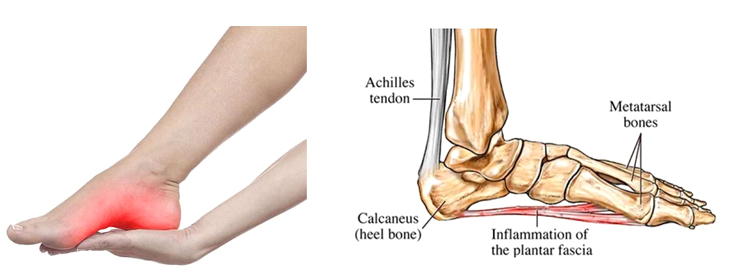 plantar