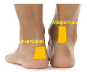 Achilles Tendinopathy Management 2 achillies 2